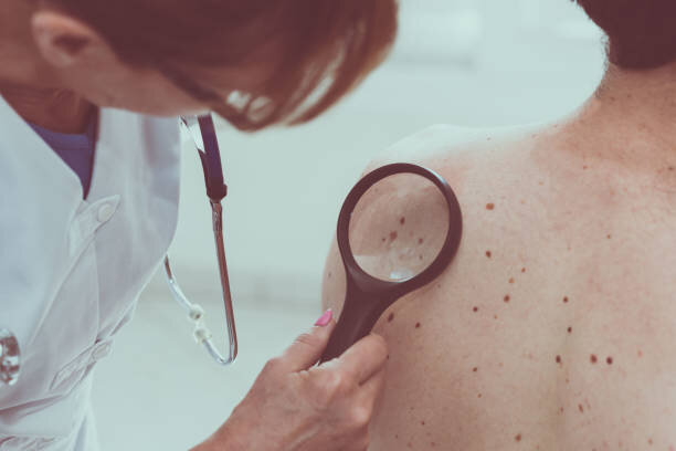 Types of Skin Cancer 3