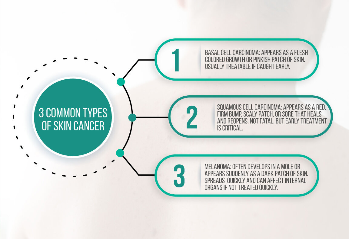 common types of skin cancer.jpg