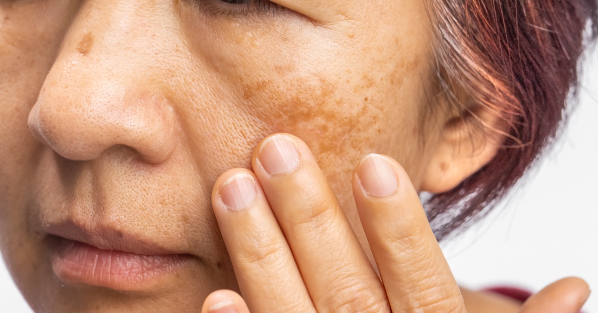 The Marietta Dermatologist's Guide to Melasma