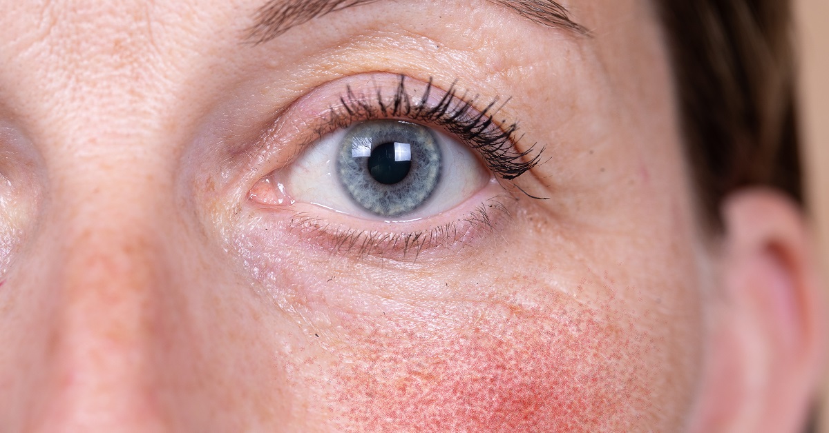 The Marietta Dermatologist's Guide to Rosacea