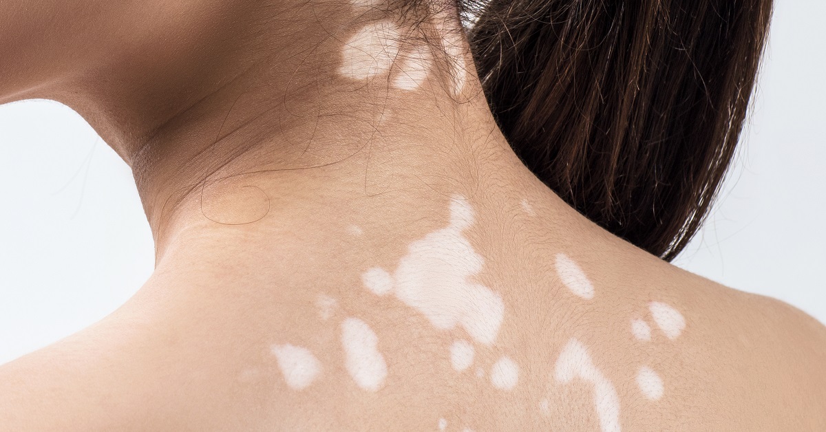 The Marietta Dermatologist's Guide to Vitiligo