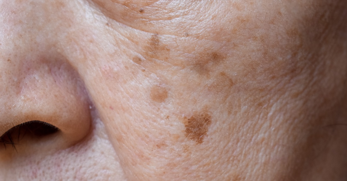 A Marietta Dermatologist’s Guide to Age and Liver Spots