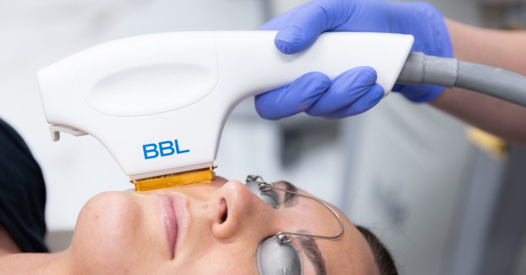 How to Prepare for Your First BBL Photofacial Treatment