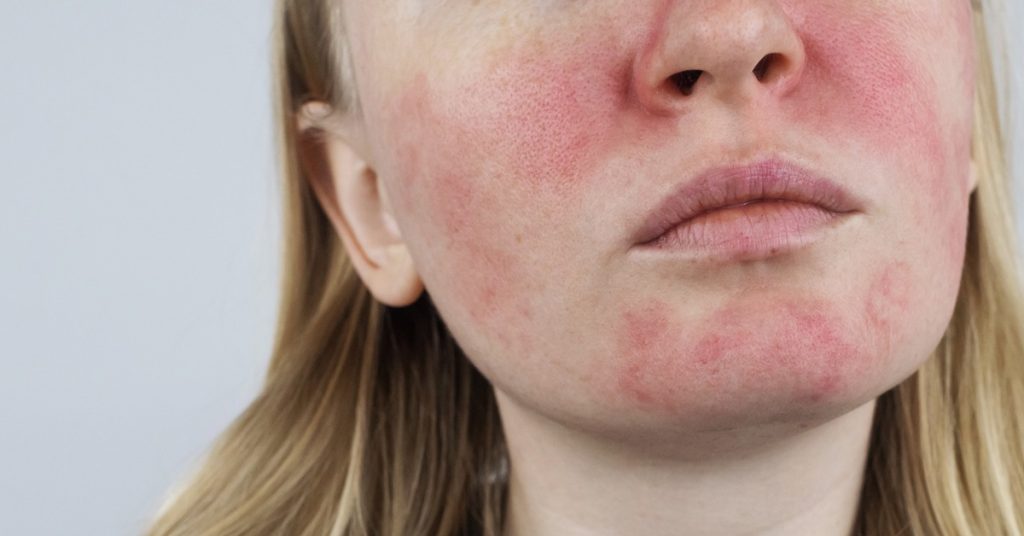 Managing Rosacea in Atlanta’s August Heat