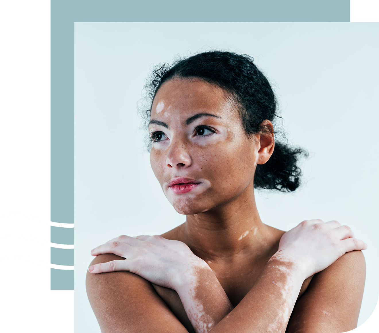 a woman with vitiligo