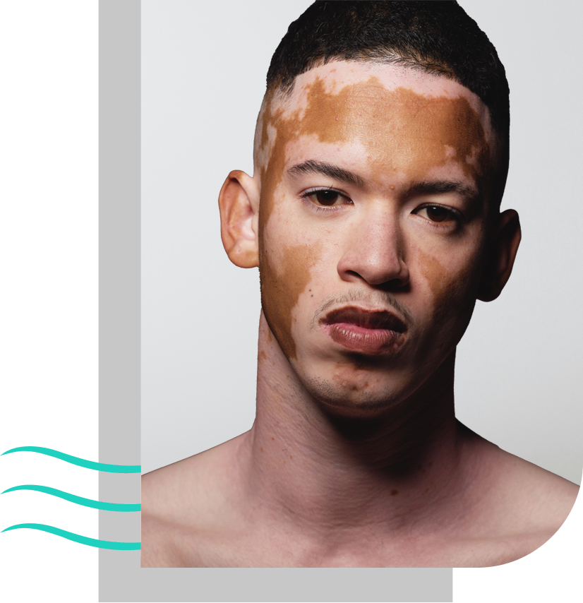 a man with vitiligo