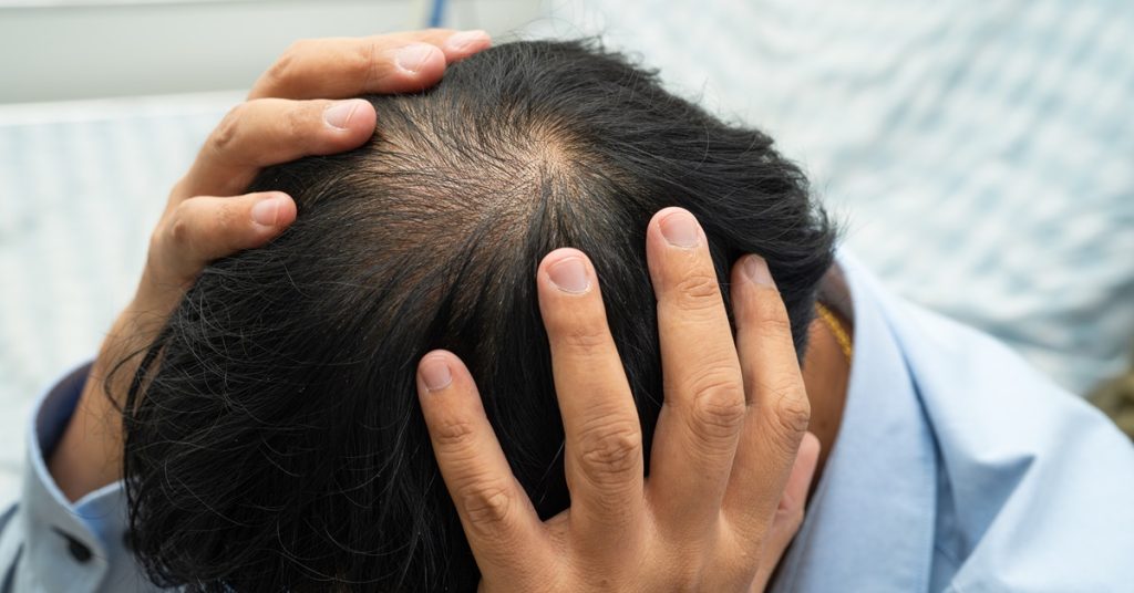 Understanding Alopecia in Marietta