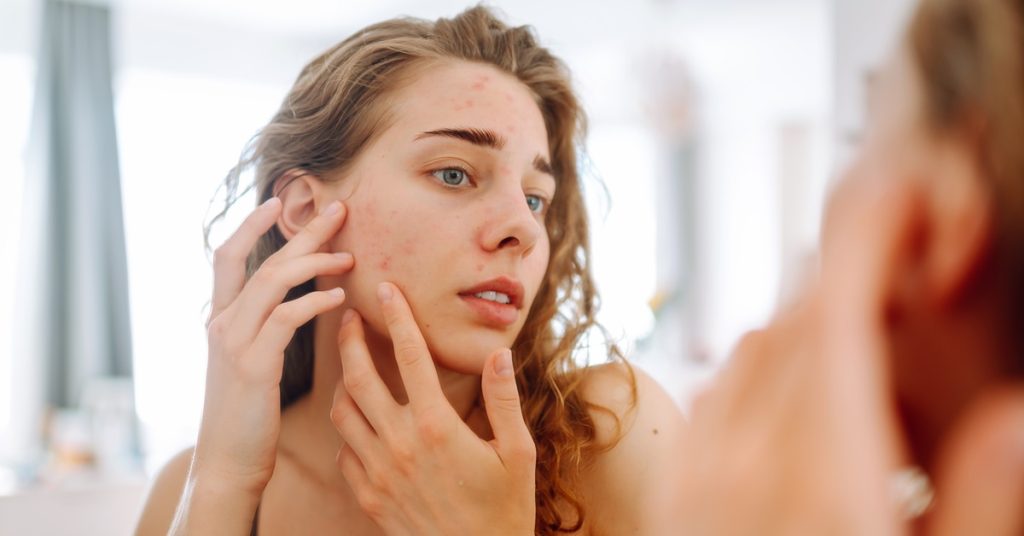 Beat the Heat and the Breakouts: The Best Acne Solutions for Atlanta Summers